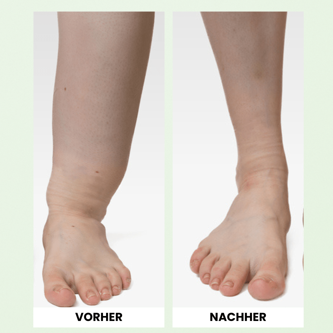 OrthoMax® Thérapie Lymphatique